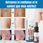 Charger l'image dans la galerie, Spray Contre les Varices BN